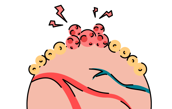 tutorial_term_cancer-dictionary-carsinoma-in-situ.png